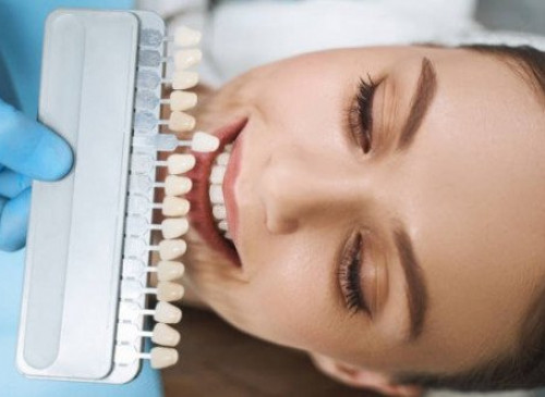 Les facettes dentaires – Un sourire parfait ?